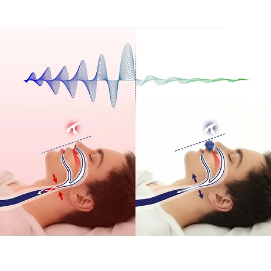 Anti-Snurkapparaat | Draadloos en Maskervrij Micro-CPAP voor Betere Nachtrust